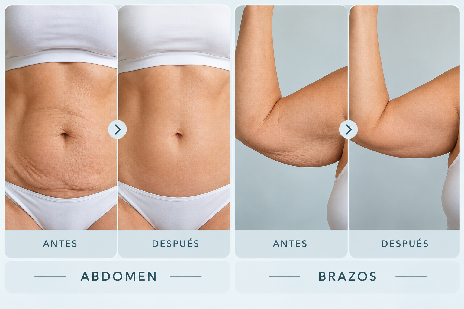 Comparación visual de antes y después en abdomen y brazos